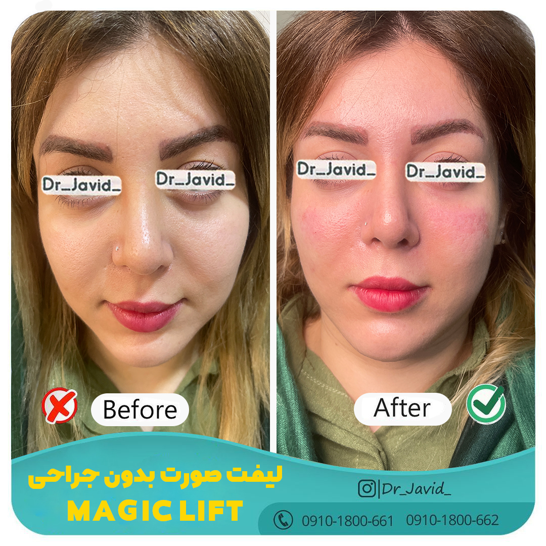 مجیک لیفت - Magic Lift